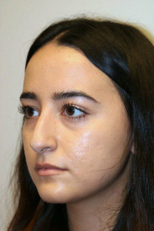 Rhinoplasty Before and After 15 | ARC Plastic Surgery