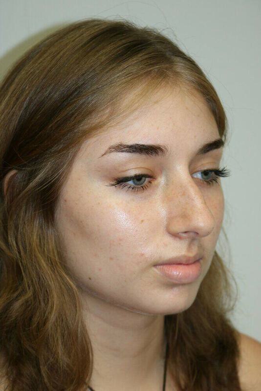 Rhinoplasty Before & After Image