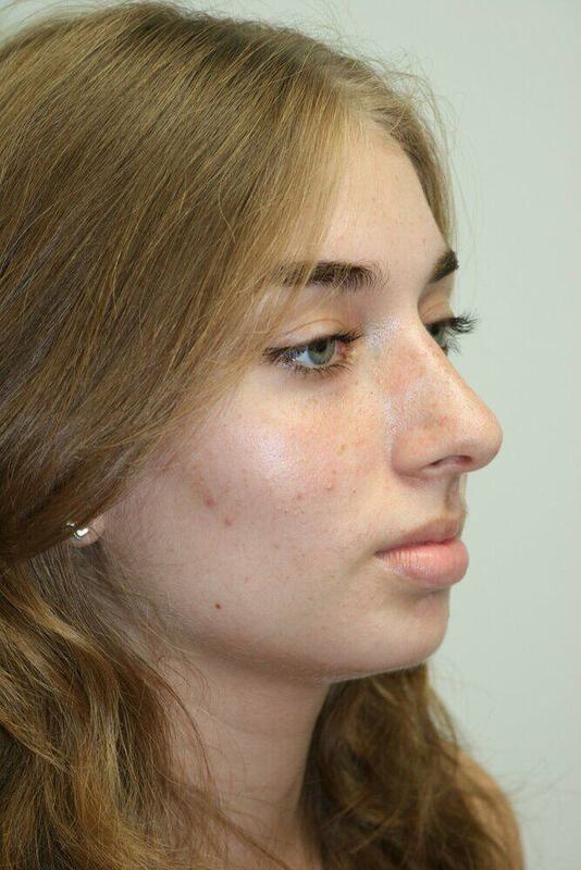 Rhinoplasty Before & After Image