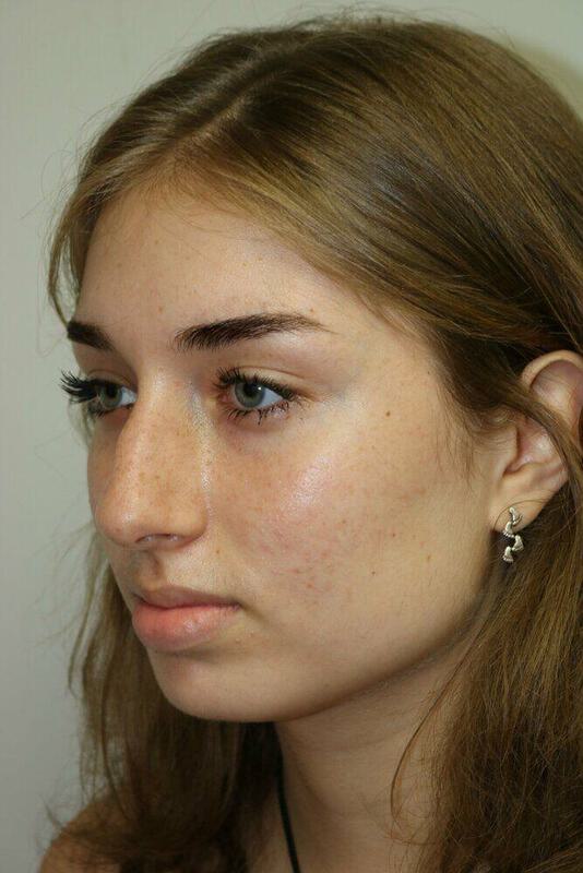 Rhinoplasty Before & After Image