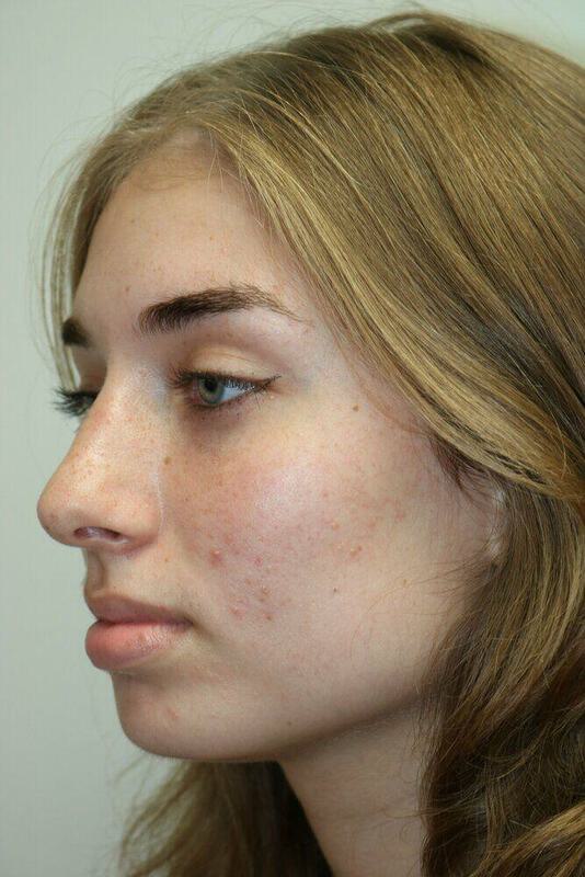 Rhinoplasty Before & After Image