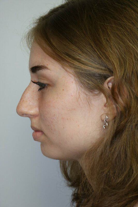 Rhinoplasty Before & After Image