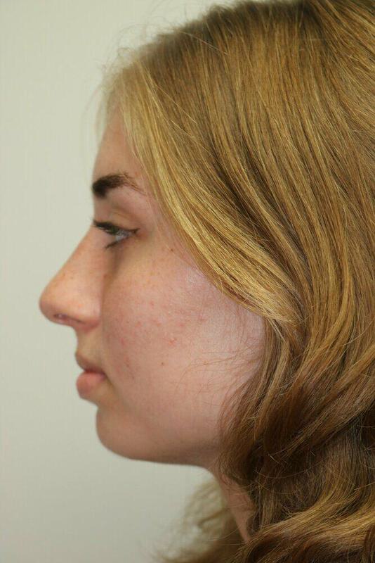 Rhinoplasty Before & After Image