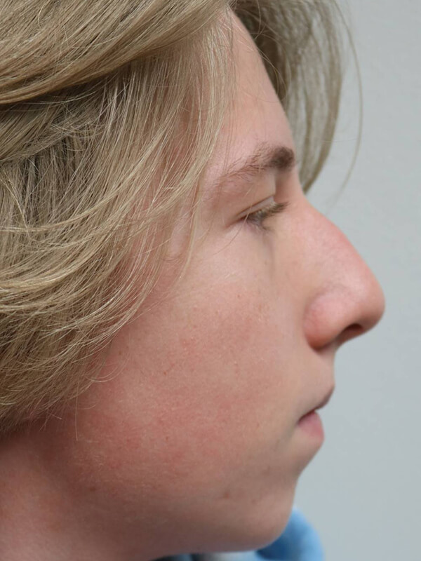 Rhinoplasty Before & After Image