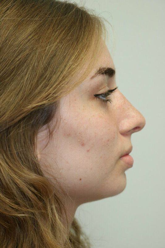 Rhinoplasty Before and After 16 | ARC Plastic Surgery