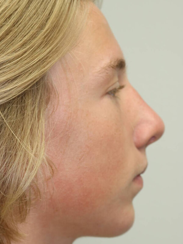 Rhinoplasty Before & After Image