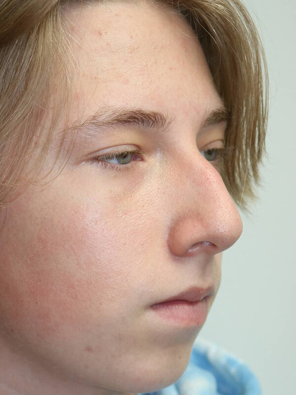 Rhinoplasty Before & After Image