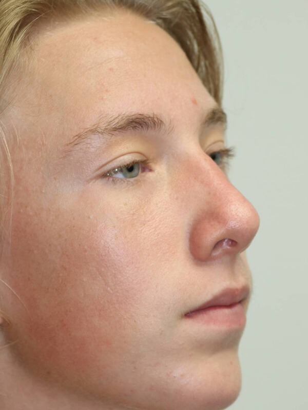 Rhinoplasty Before & After Image