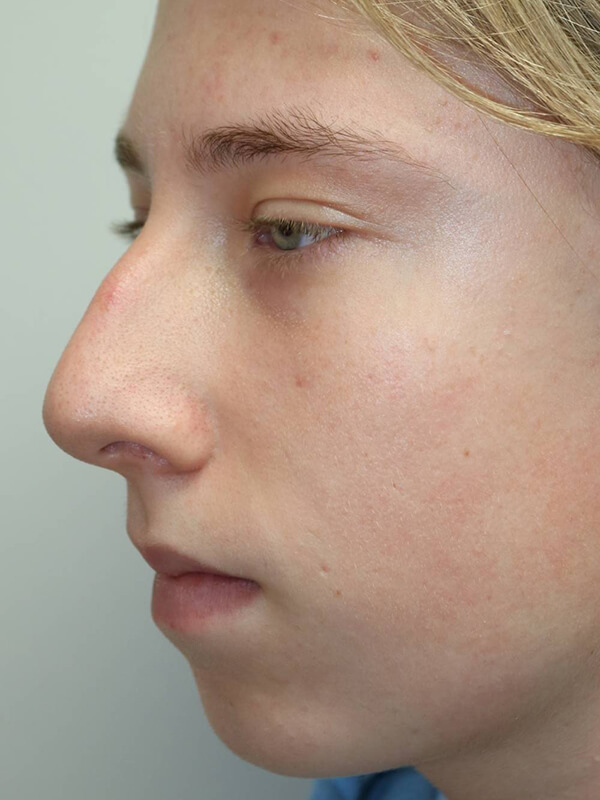 Rhinoplasty Before & After Image