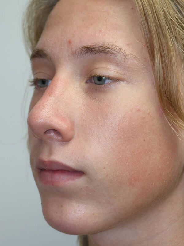 Rhinoplasty Before & After Image