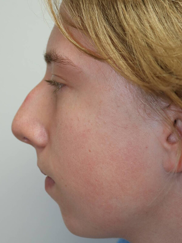 Rhinoplasty Before & After Image