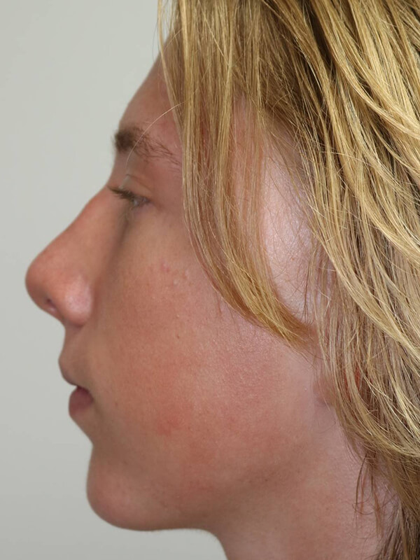 Rhinoplasty Before & After Image