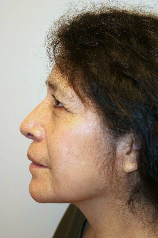 Rhinoplasty Before & After Image