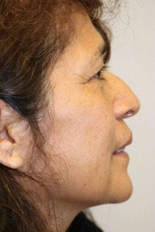 Rhinoplasty Before & After Image