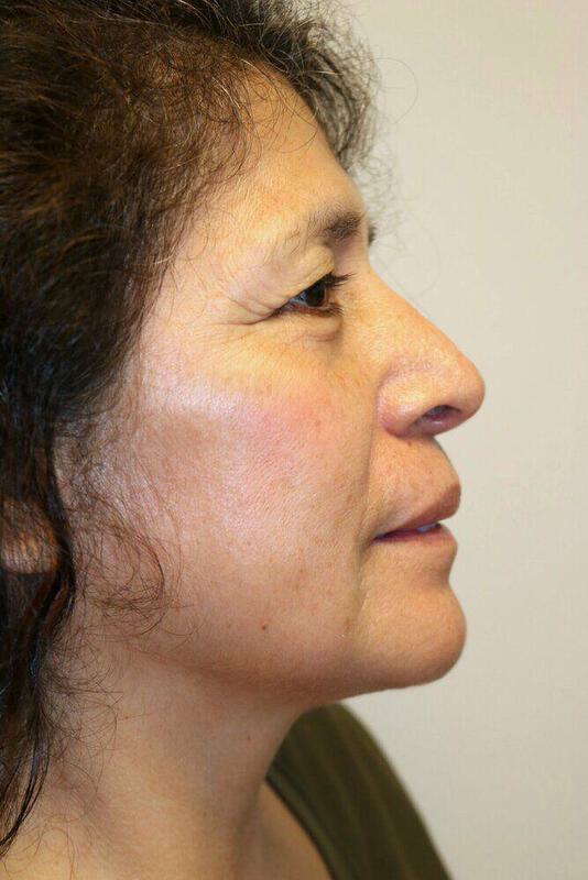 Rhinoplasty Before & After Image