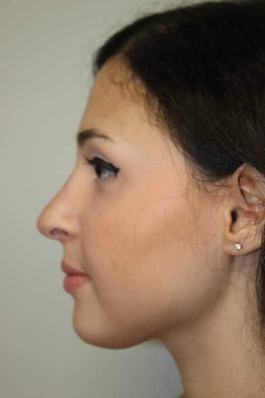 Rhinoplasty Before & After Image