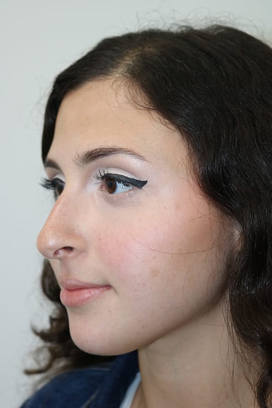 Rhinoplasty Before & After Image