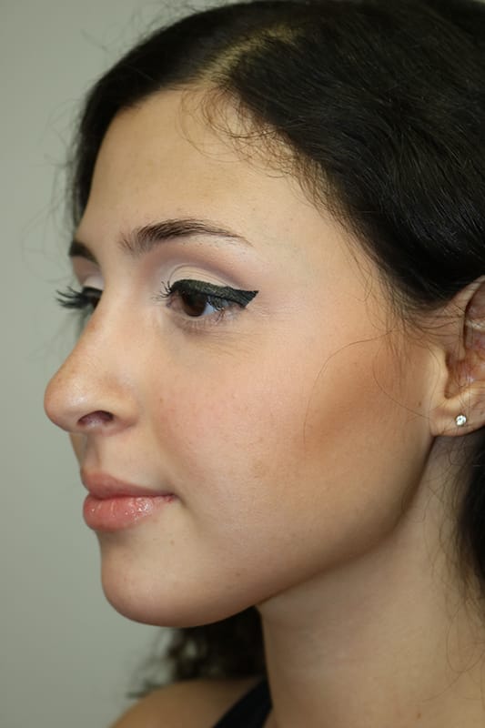 Rhinoplasty Before & After Image