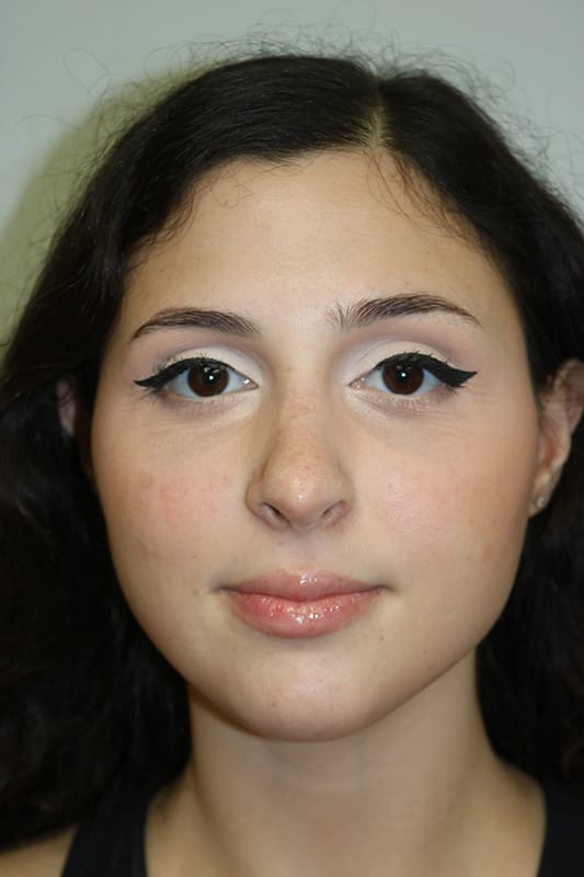 Rhinoplasty Before & After Image