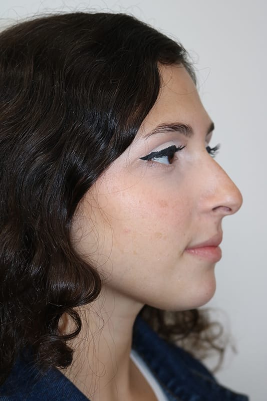 Rhinoplasty Before & After Image