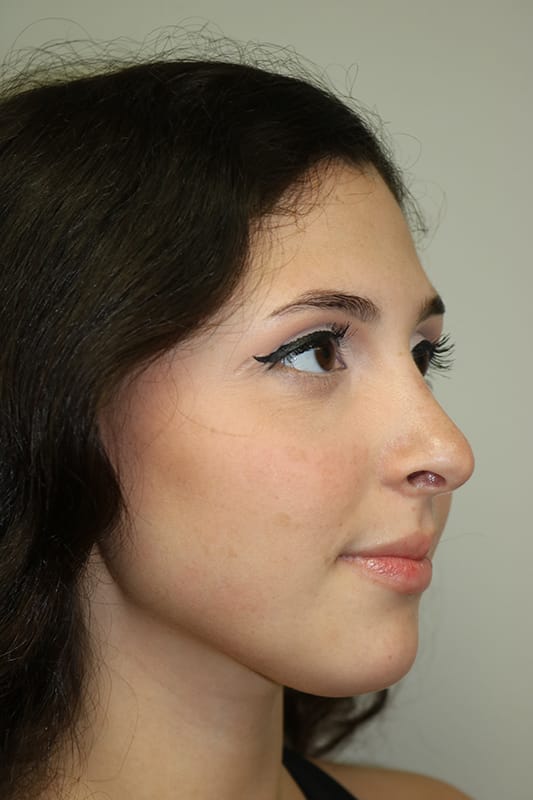 Rhinoplasty Before & After Image