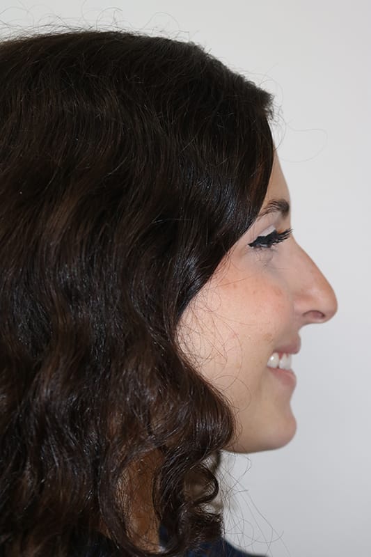 Rhinoplasty Before & After Image