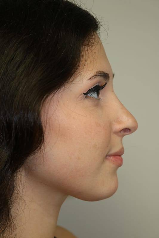 Rhinoplasty Before & After Image