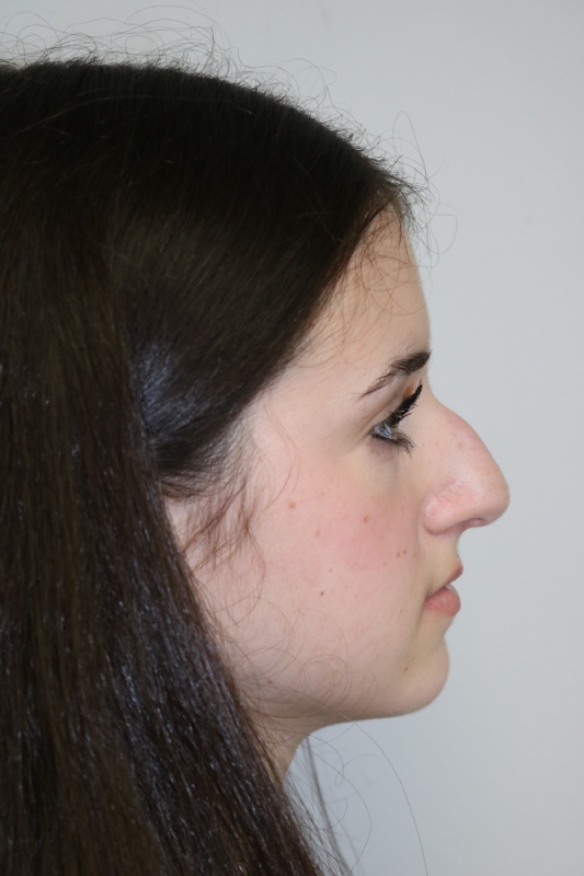 Rhinoplasty Before & After Image