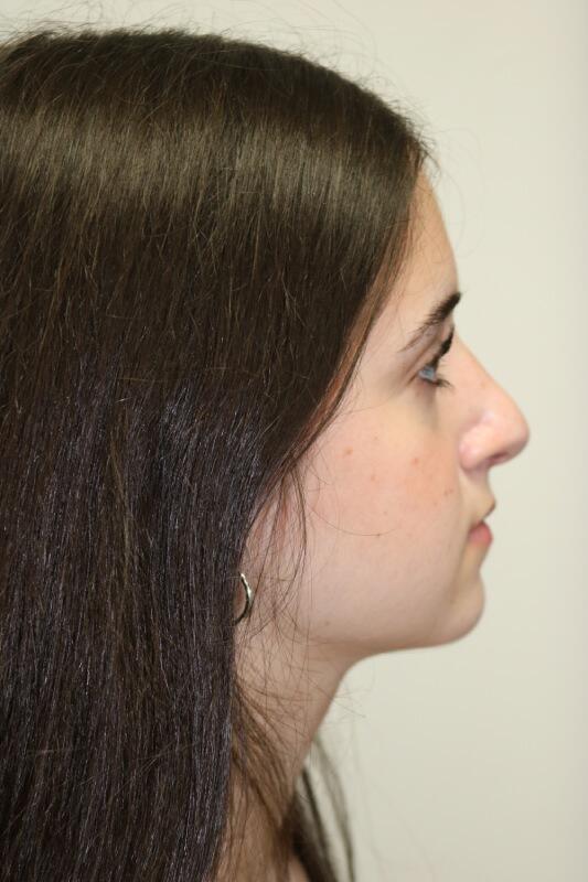 Rhinoplasty Before & After Image