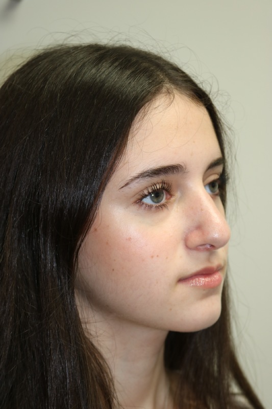 Rhinoplasty Before & After Image