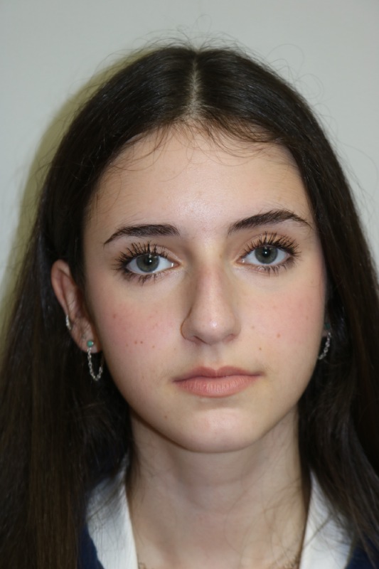 Rhinoplasty Before & After Image