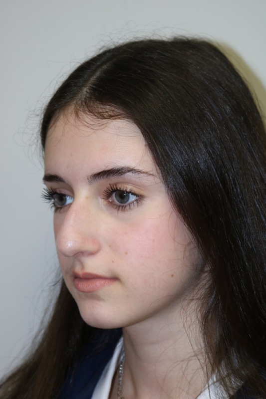 Rhinoplasty Before & After Image