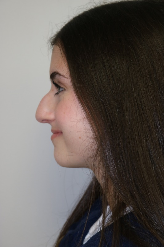 Rhinoplasty Before & After Image