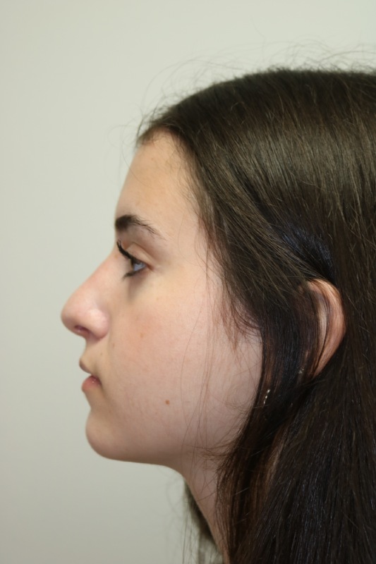 Rhinoplasty Before & After Image