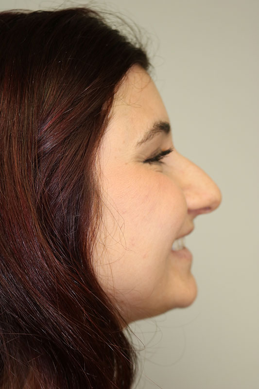 Rhinoplasty Before & After Image