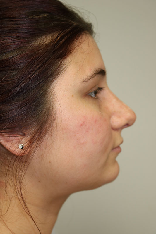 Rhinoplasty Before & After Image