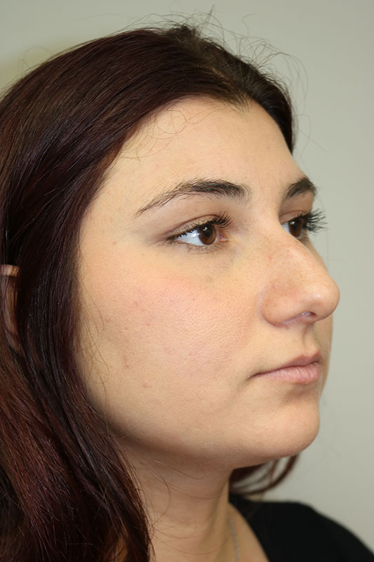 Rhinoplasty Before & After Image