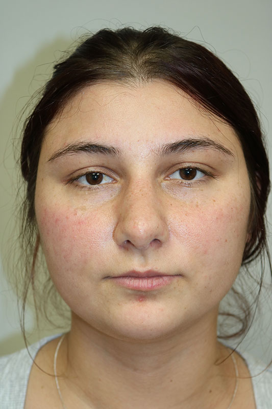 Rhinoplasty Before & After Image