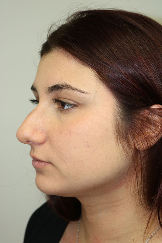 Rhinoplasty Before & After Image