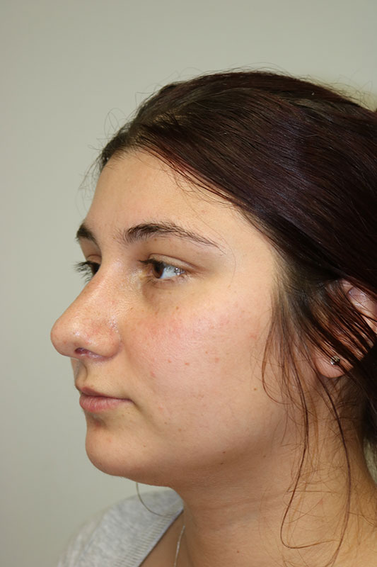 Rhinoplasty Before & After Image