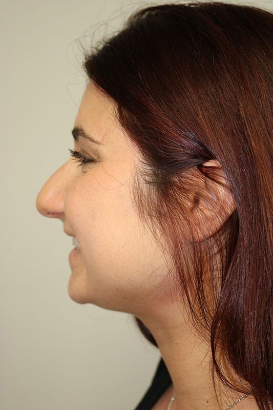 Rhinoplasty Before & After Image