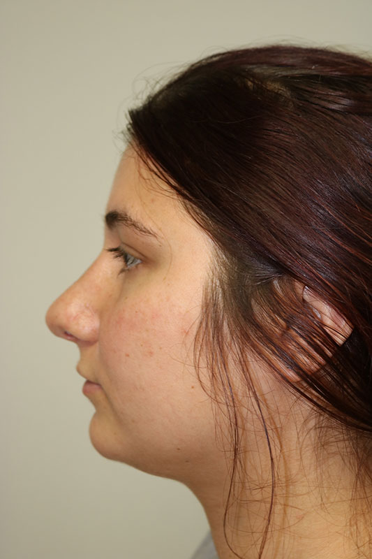 Rhinoplasty Before & After Image