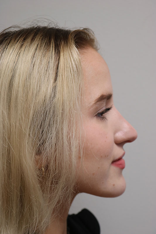 Rhinoplasty Before & After Image