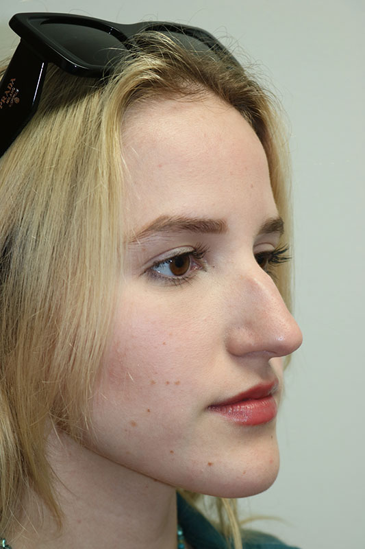 Rhinoplasty Before & After Image