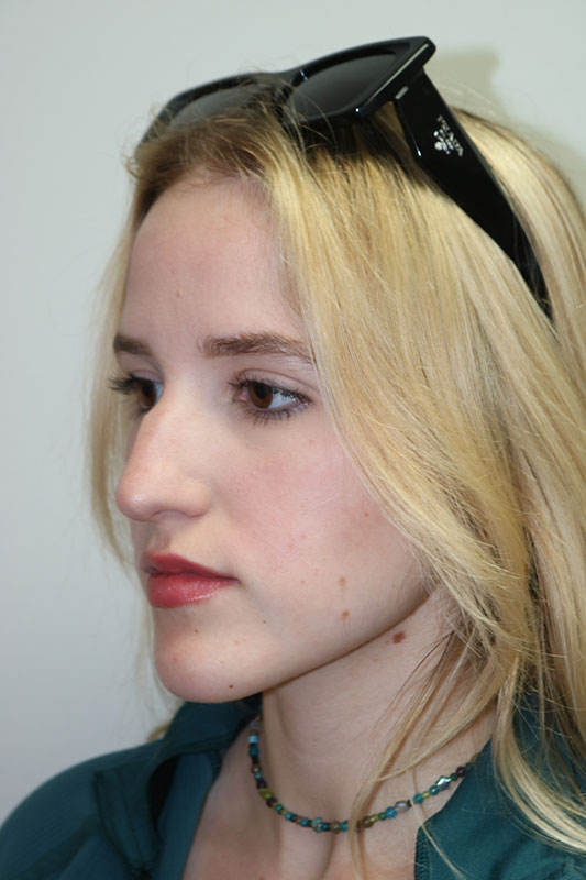 Rhinoplasty Before & After Image