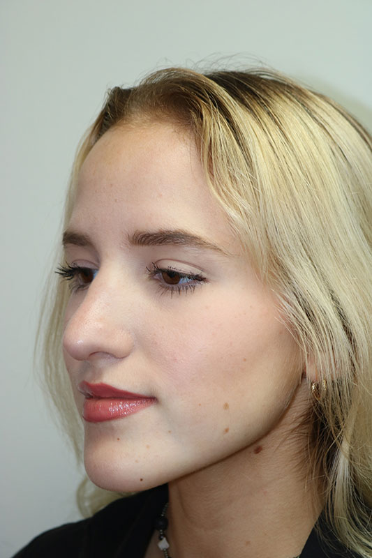 Rhinoplasty Before & After Image