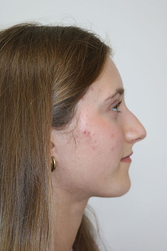 Rhinoplasty Before & After Image