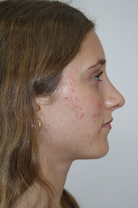 Rhinoplasty Before & After Image