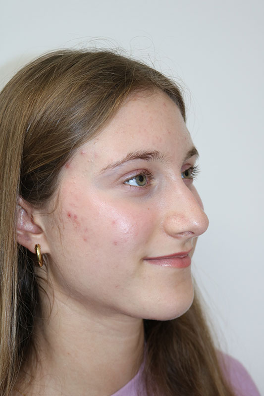 Rhinoplasty Before & After Image