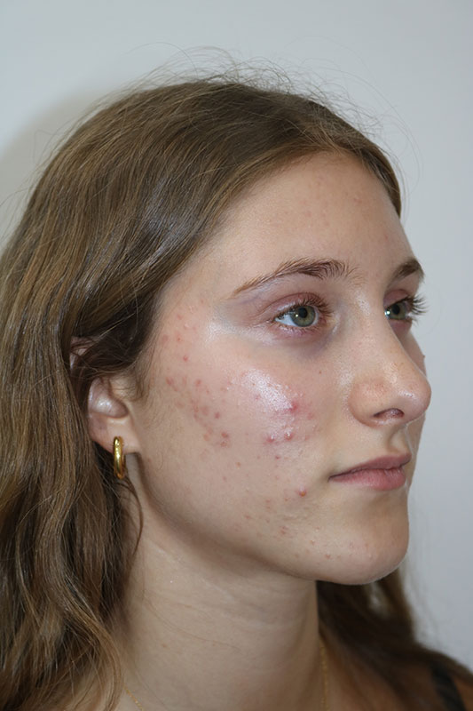 Rhinoplasty Before & After Image